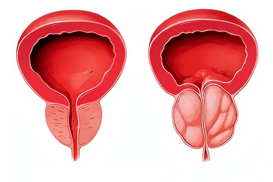 inflamed and healthy prostate