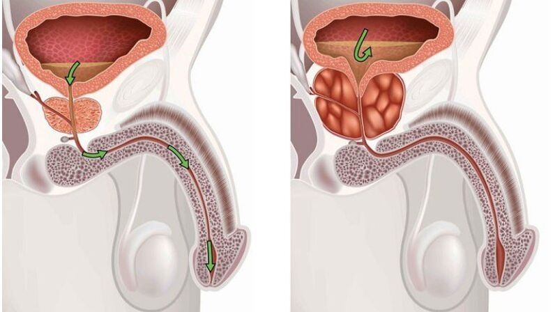 healthy and enlarged prostate with inflammation of the prostate