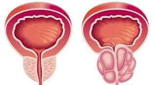 causes of prostatitis and prostate adenoma